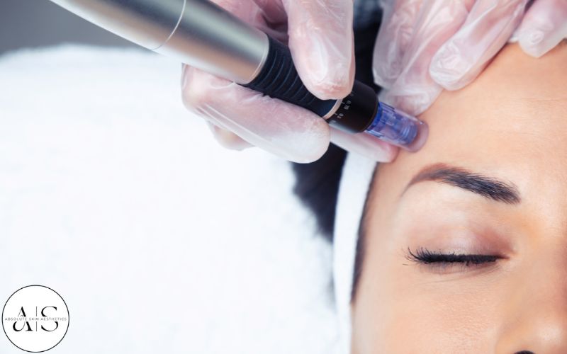 microneedling skin therapy